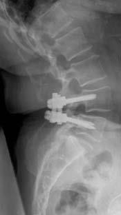X-ray of spinal fusion