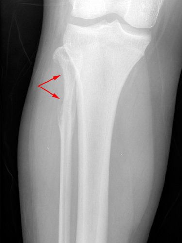 X-ray of knee with Ewing's sarcoma