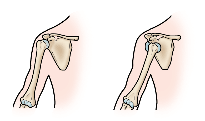 Illustration of normal shoulder stability and shoulder dislocation 