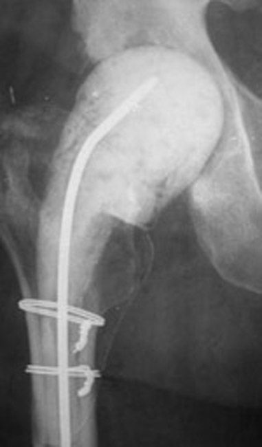 An antibiotic spacer in a hip joint
