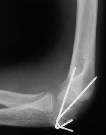 Elbow fracture treated with pins