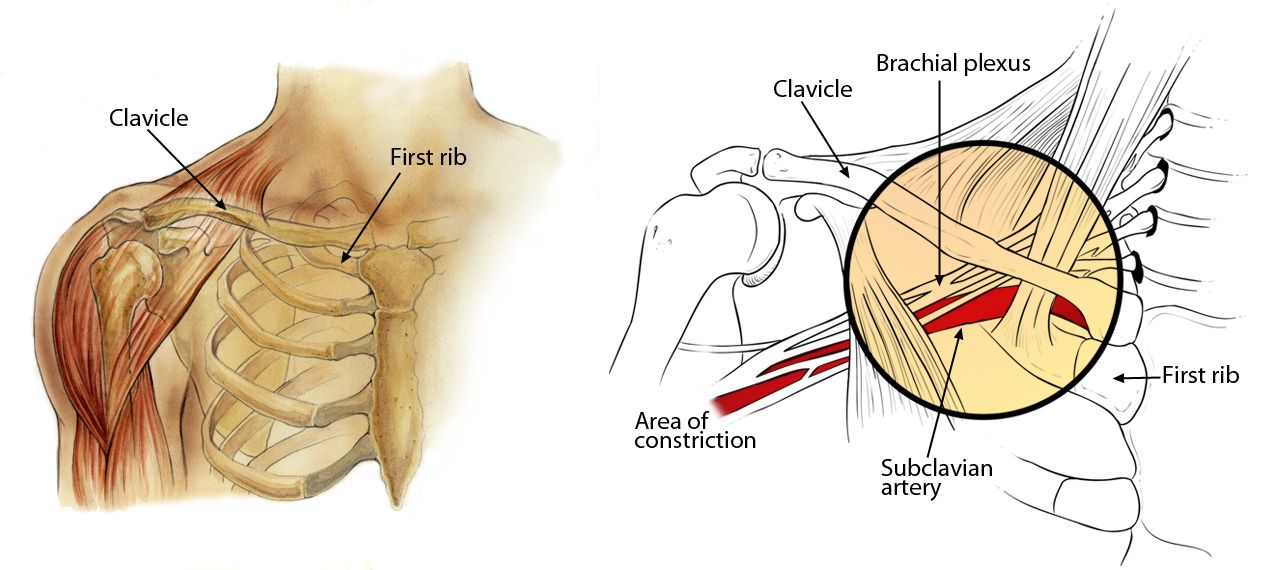 Anatomy illustration, including the location of the thoracic outlet