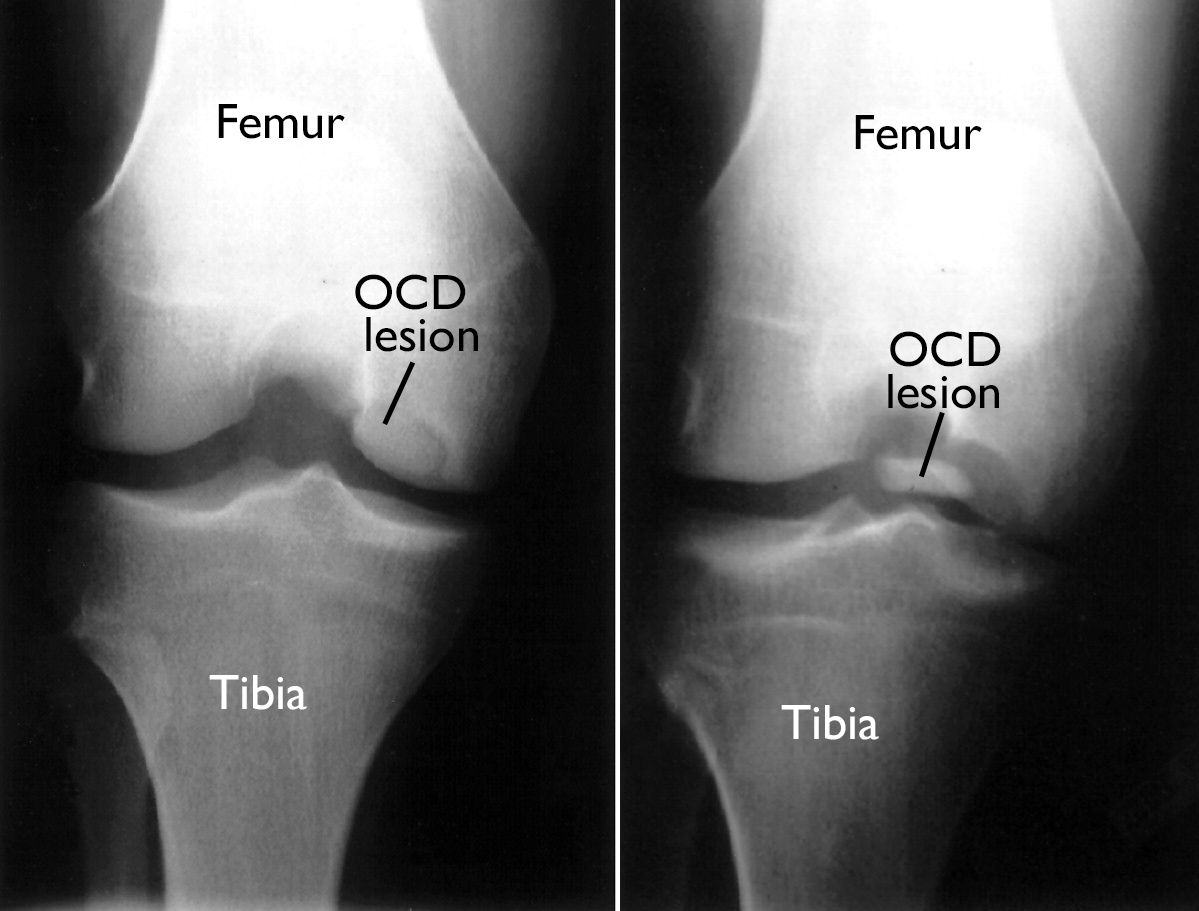 x-rays of OCD lesion