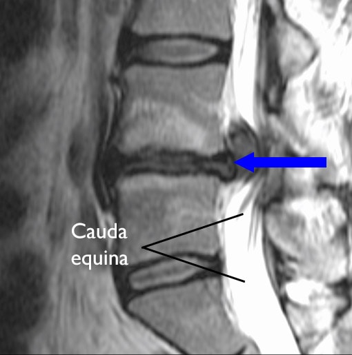 Herniated disk compressing cauda equina