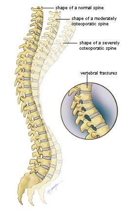 Normal spine versus osteoporatic spine