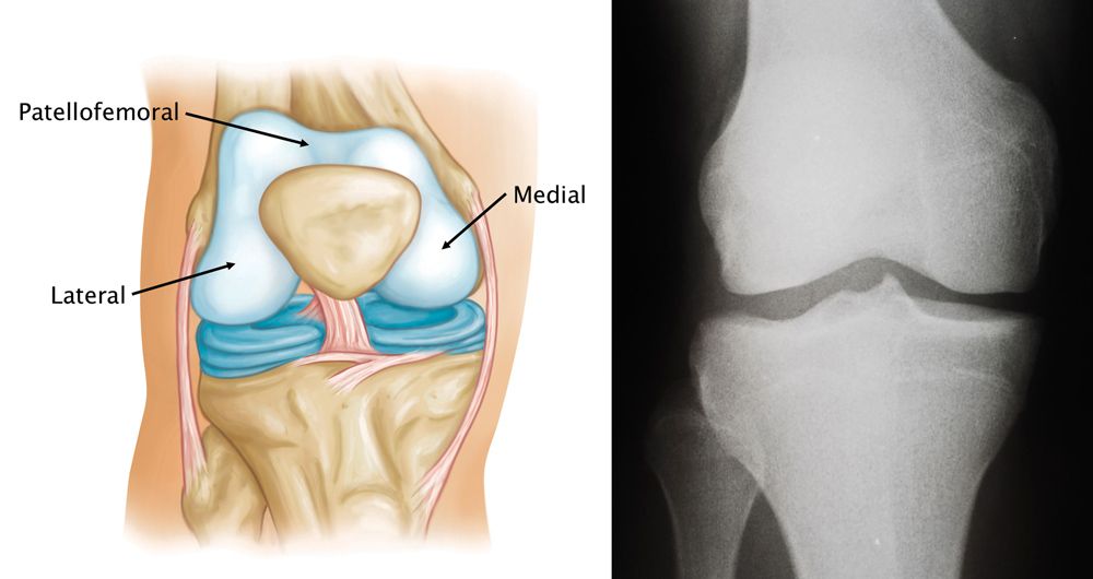 Normal knee anatomy, including the medial, lateral, and patellofemoral compartments