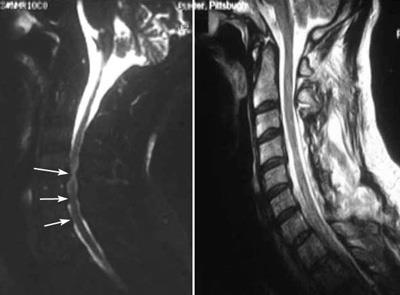 MRI scans of spinal cord compression and laminoplasty