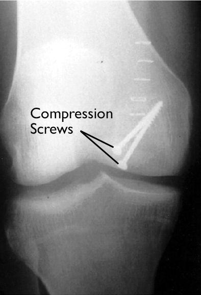 OCD lesion in knee fixed with screws