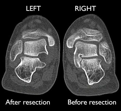 x-ray of resection for tarsal coaltion