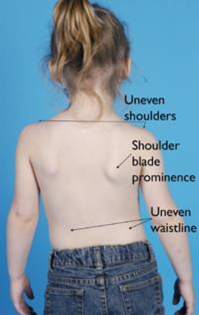 photo of 4-year-old girl with congenital scoliosis