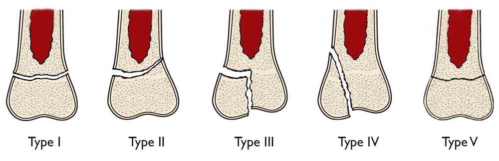 Salter-Harris classification of growth plate fractures. 