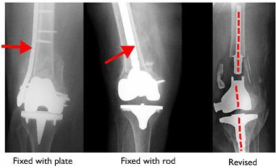 Fractures near artificial knee joint treated with internal fixation and revision knee replacement