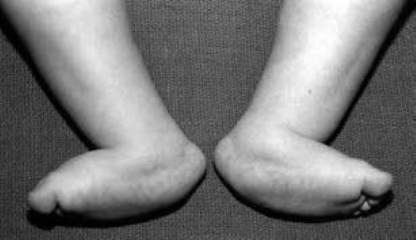 vertical talus in bone feet