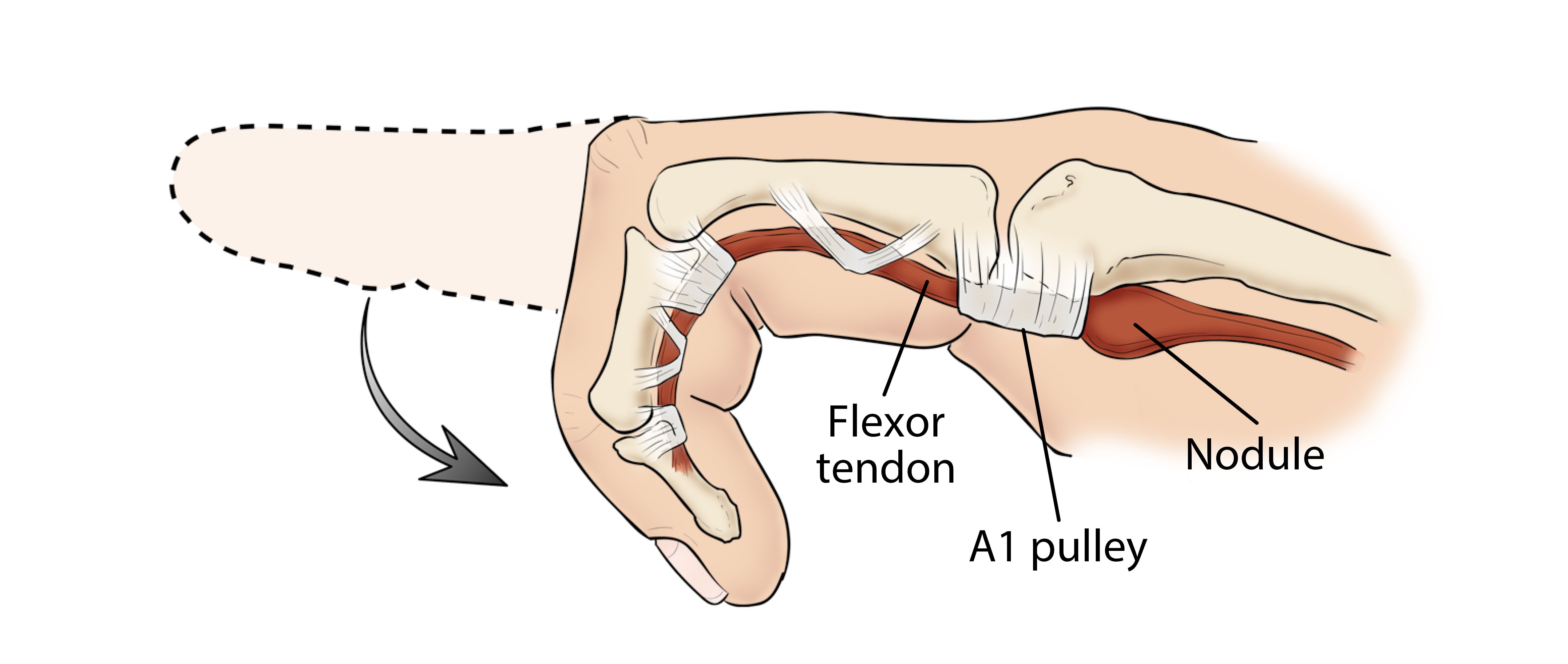 Nodule on flexor tendon