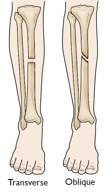 Transverse and oblique tibial shaft fractures