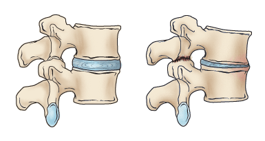 A normal spinal segment and a collapsed segment of spine
