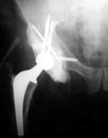 special hip replacement for metastatic bone disease