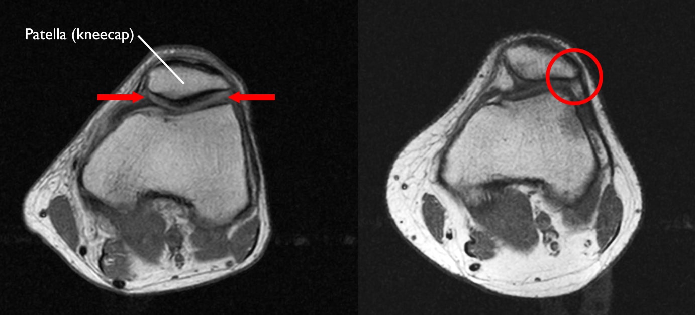 normal knee and knee of of alignment