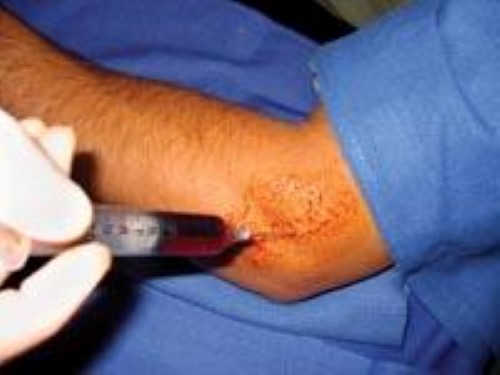 PRP injection for tennis elbow