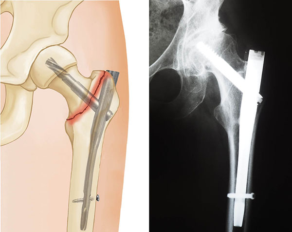 hip fracture treated with intramedullary nail