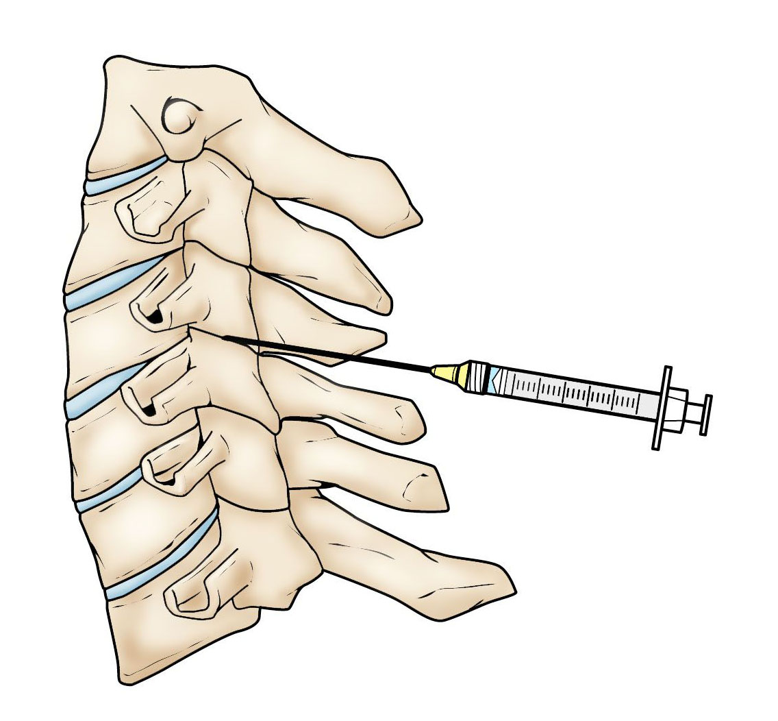Facet joint injection in the cervical spine