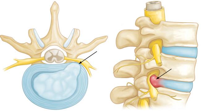 Cross-section and side views of a herniated disk
