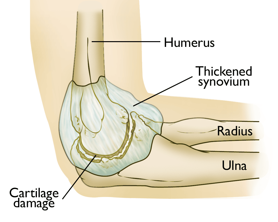 elbow arthritis