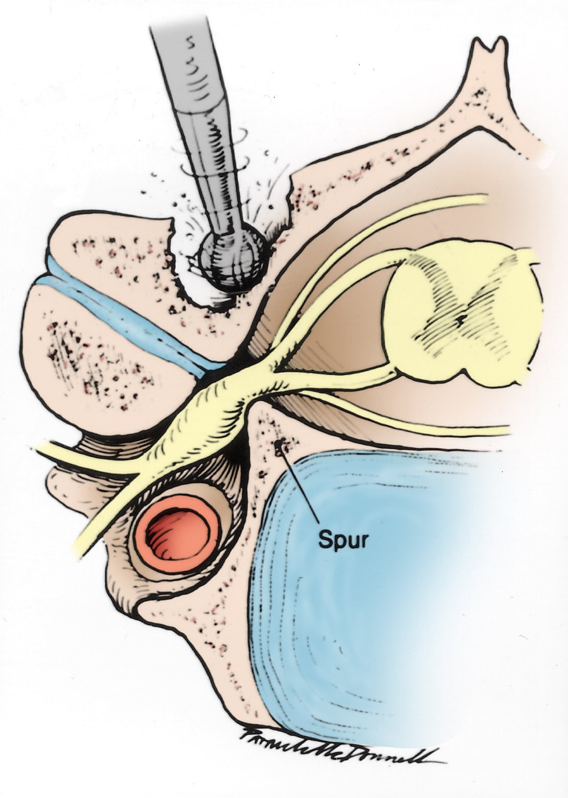 Illustration of a posterior cervical laminoforaminotomy