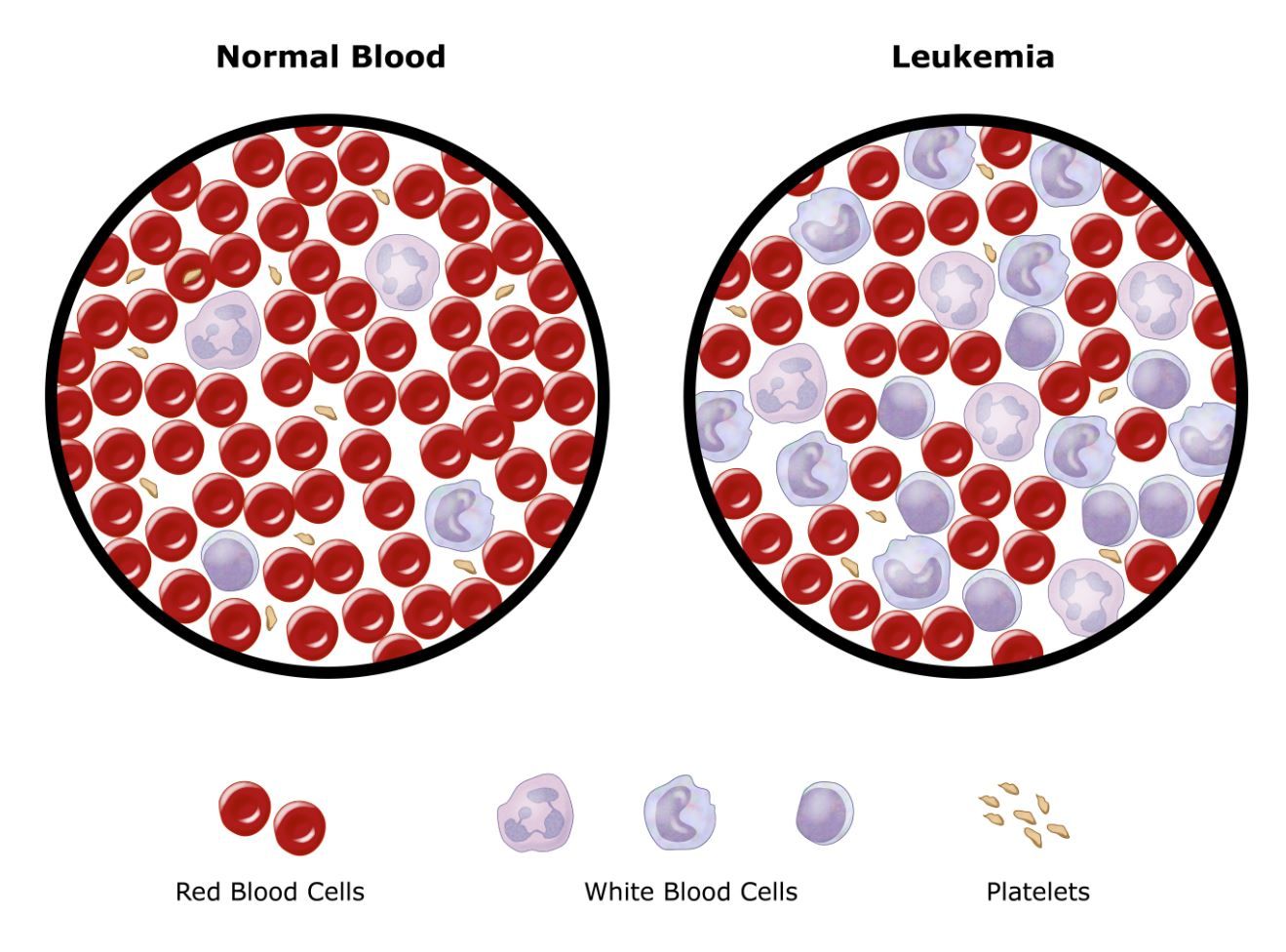 Illustration of normal blood cells and leukemia cells