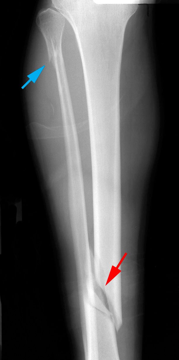 Oblique tibial shaft fracture