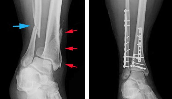X-rays of tibial shaft fracture and internal fixation