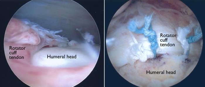 arthroscopic photos of a rotator cuff tear and surgical repair