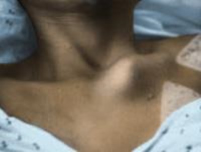 signs of anterior sternoclavicular dislocation