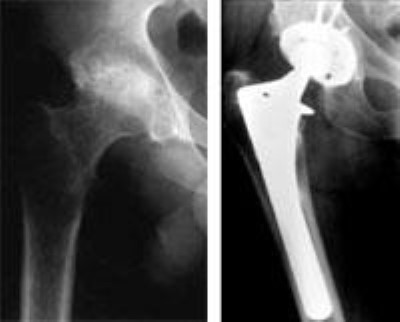 X-rays of hip with rheumatoid arthritis before and after total hip replacement