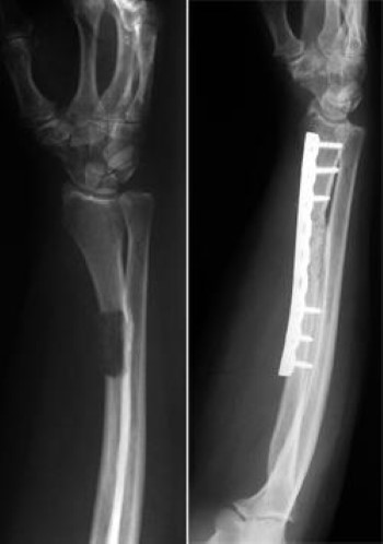tumor in forearm stabilized with plate and screws