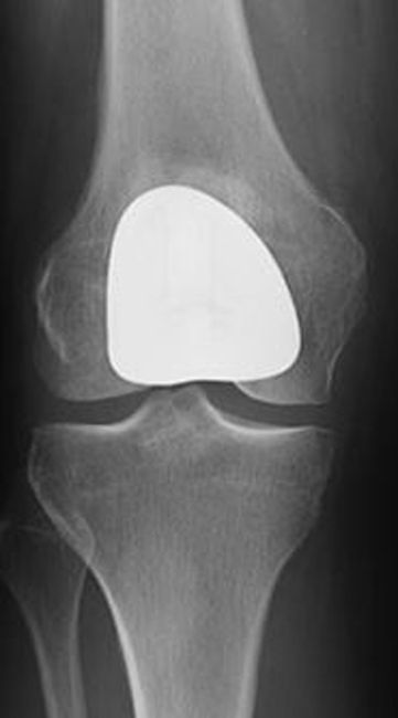Front view of a knee after patellofemoral replacement