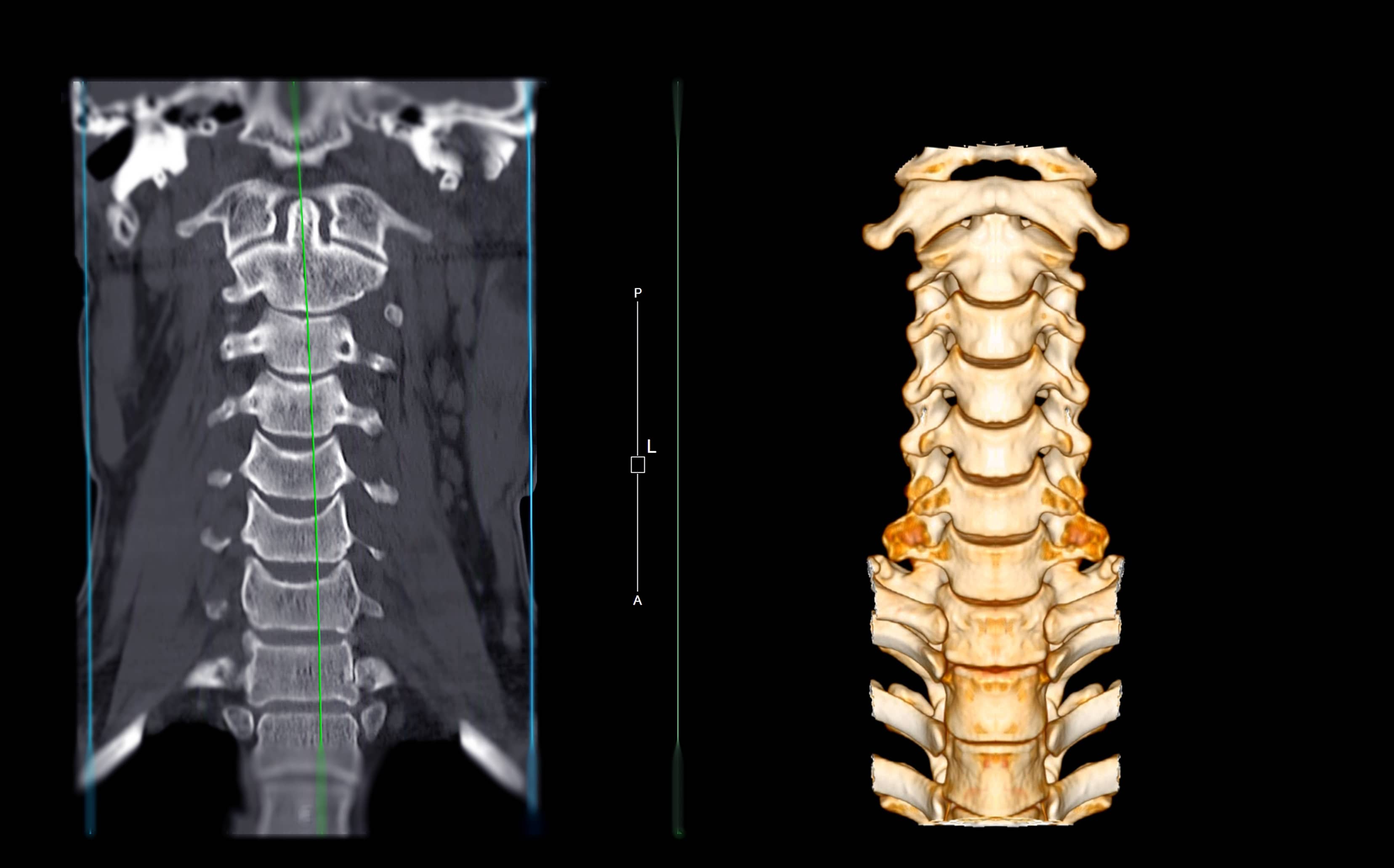 CT Scan of Cervical Spine (C-spine)