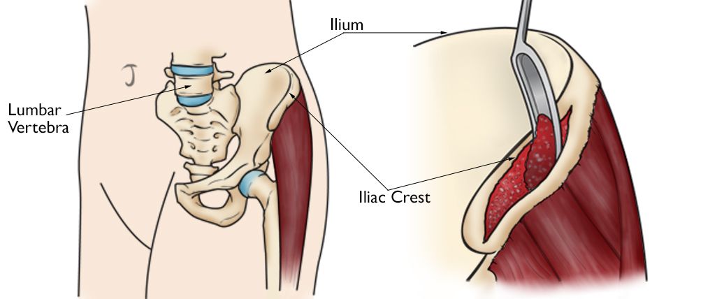 autograft harvested from iliac crest