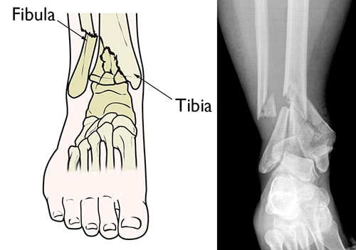 Illustration and x-ray of a pilon fracture