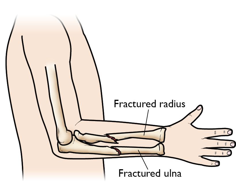 Fractures in the radius and ulna