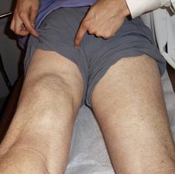 Photo  of patient with severe hamstring injury