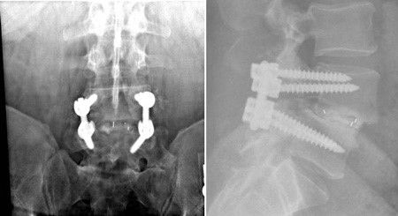 x-rays of TLIF procedure