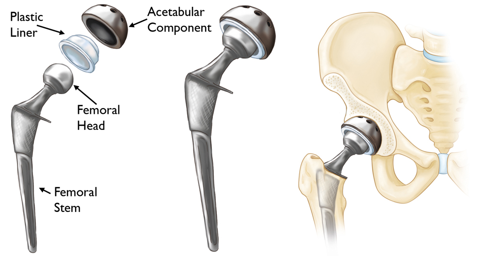 Components used in primary total hip replacement 
