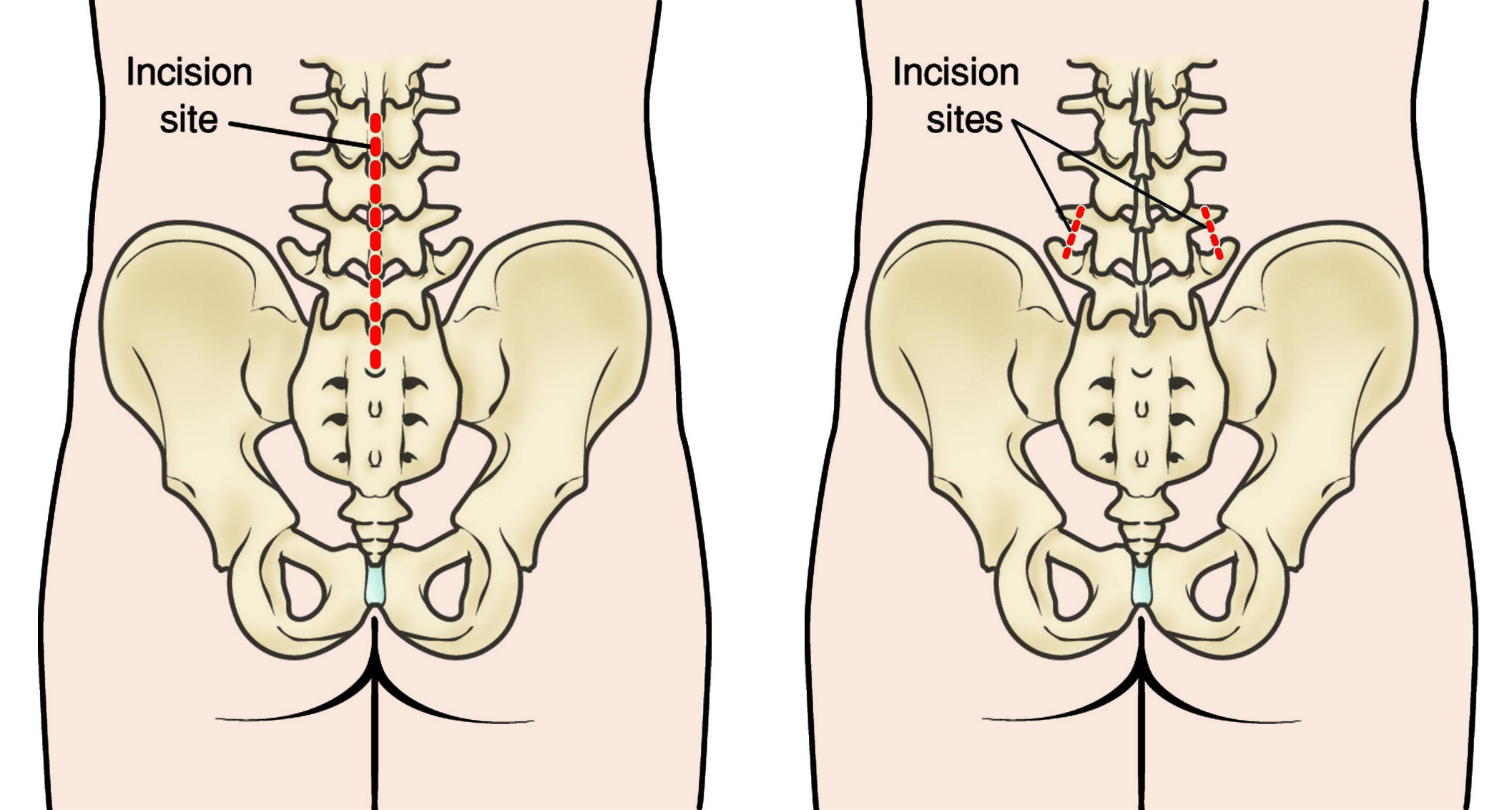 Incision sites for open surgery and minimally invasive surgery