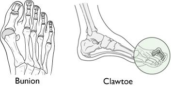 Illustration of bunion and claw toe