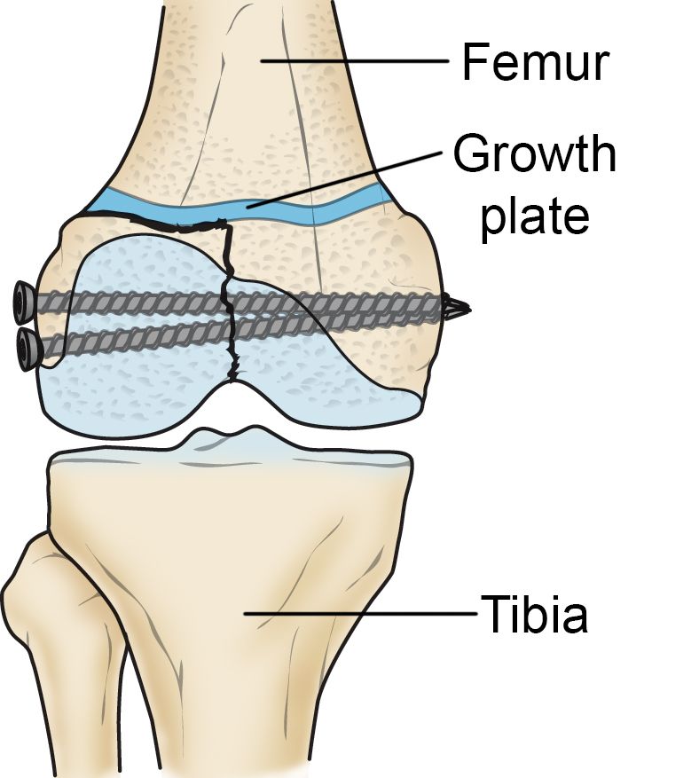 Growth plate fracture treated with internal fixation