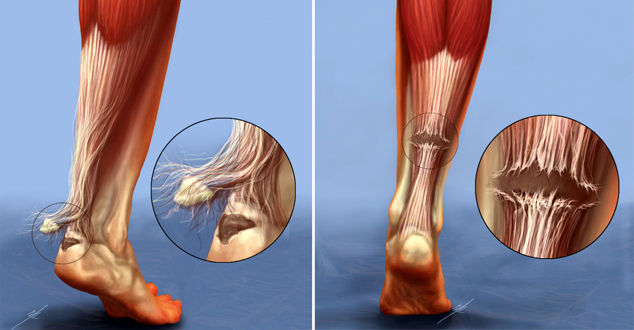 Achilles Tendon Rupture Treatment ATEEP