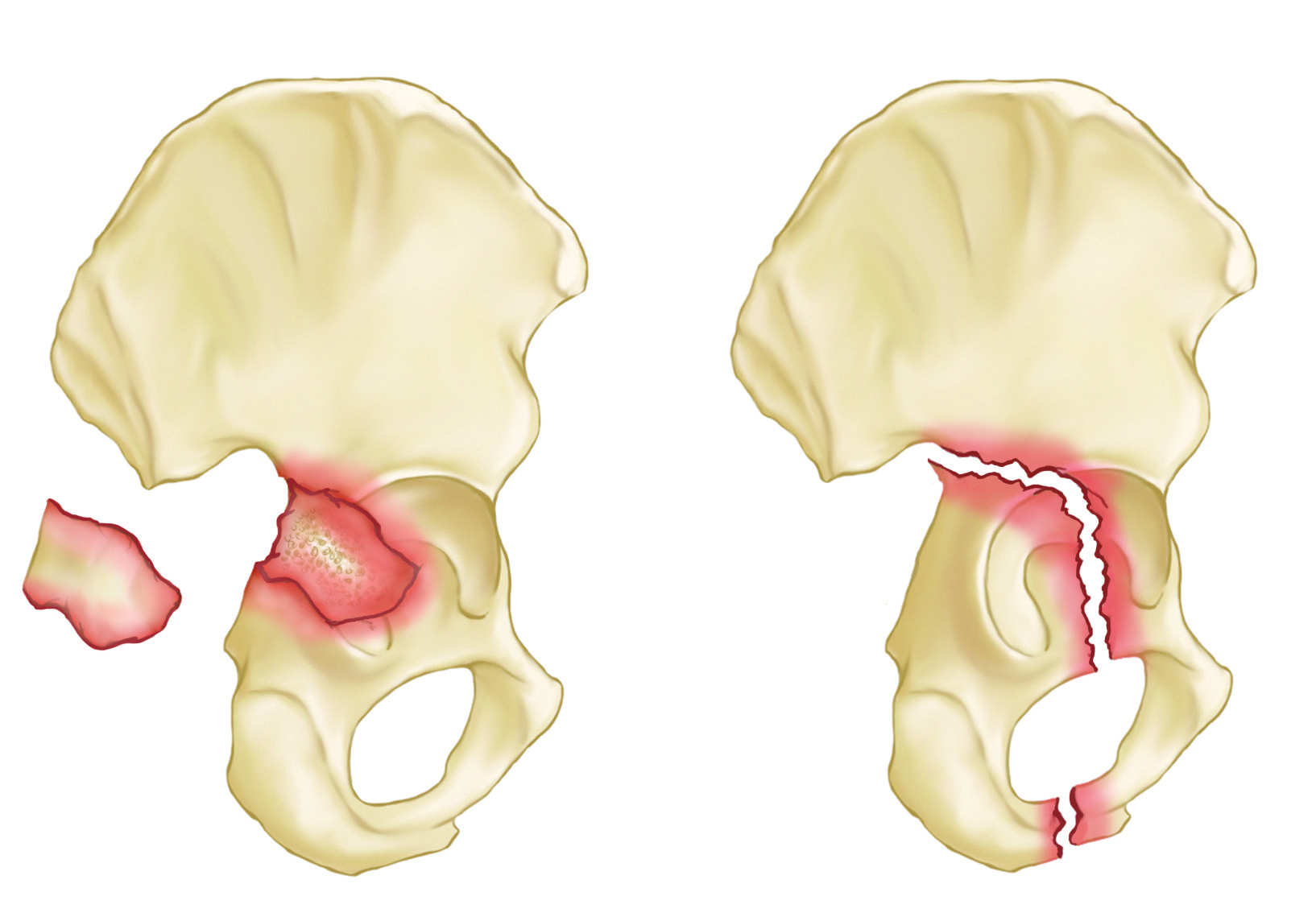 Posterior wall and posterior column acetabulum fractures
