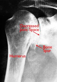 X-ray of severe osteoarthritis of the glenohumeral joint