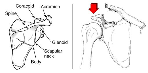 Illustrations of fracture patterns in the scapula and acromioclavicular joint dislocation
